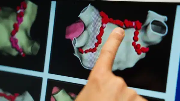 ablasyon tedavisi kalp pili ve sok piline alternatif cozum SnBks8rs