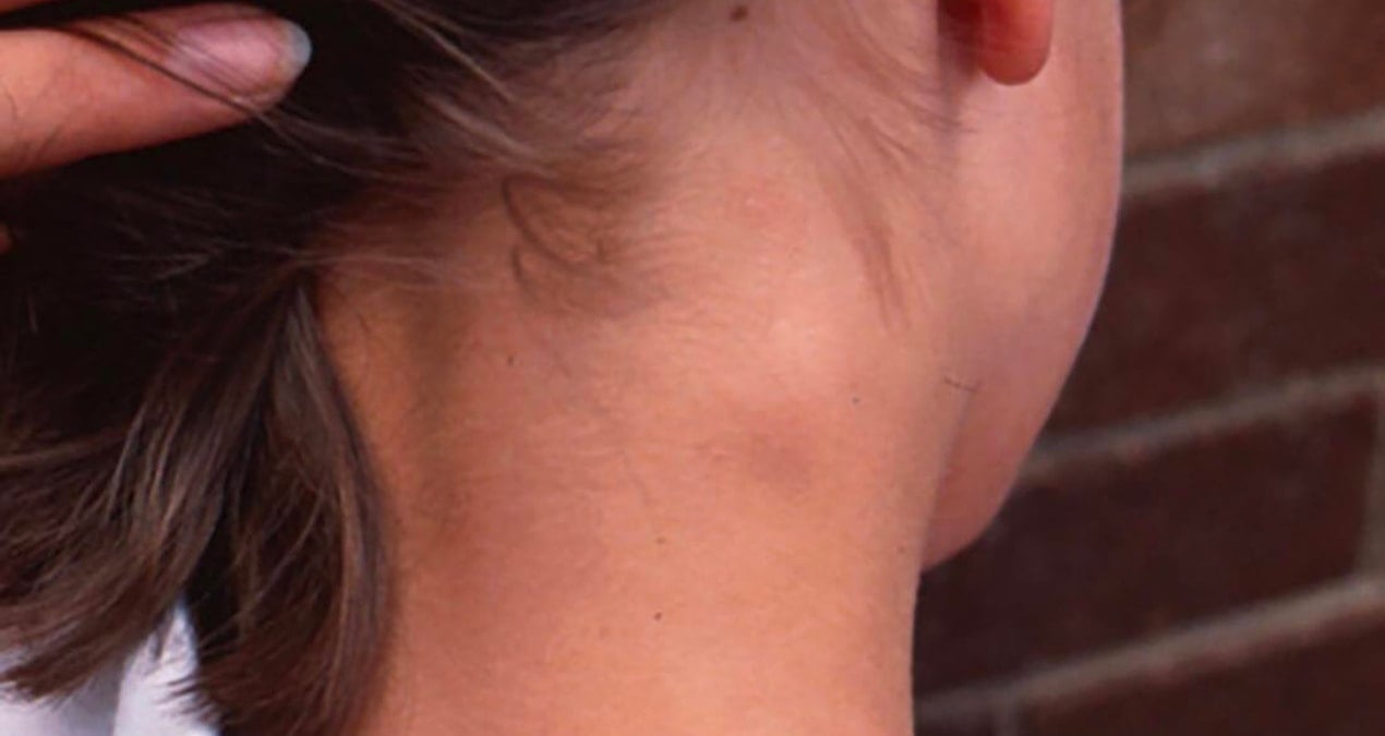 boyunda olusan sislikler ciddi hastalik belirtisi olabilir bBV7Klt3